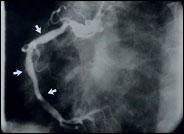 ballooning in the right coronary artery